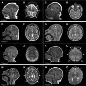 A comprehensive clinical study confirms the molecular link between microcephaly caused by Zika and ANKLE2 variants