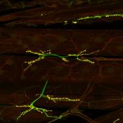 An international collaboration discovers novel neurodevelopmental syndrome