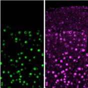 Loss of Ataxin1-Capicua complex causes a novel neurodevelopmental disorder