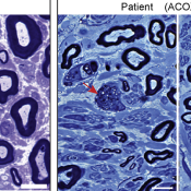 Solving the puzzle of Mitchell disease
