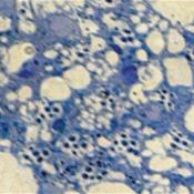 Mutations in nardilysin or OGDHL causes neurodegeneration