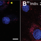 Loss of OXR1 causes lysosomal dysfunction and a novel neurodevelopmental disorder 