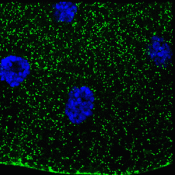 Patient-inspired research links sugar metabolism to a rare genetic disorder