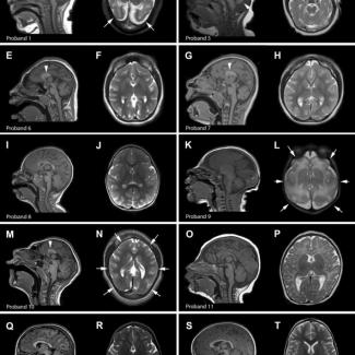 A comprehensive clinical study confirms the molecular link between microcephaly caused by Zika and ANKLE2 variants