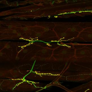 An international collaboration discovers novel neurodevelopmental syndrome