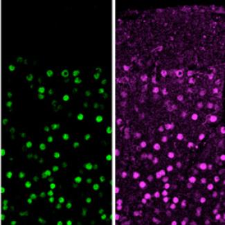 Loss of Ataxin1-Capicua complex causes a novel neurodevelopmental disorder