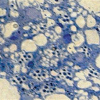 Mutations in nardilysin or OGDHL causes neurodegeneration