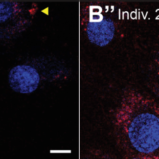 Loss of OXR1 causes lysosomal dysfunction and a novel neurodevelopmental disorder