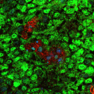 NRI researchers identify a promising drug target for childhood brain tumors
