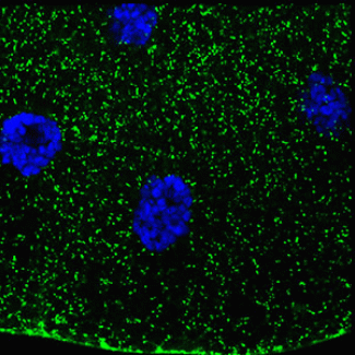 Patient-inspired research links sugar metabolism to a rare genetic disorder