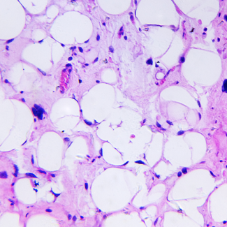 Researchers find a potential new approach to control cancer growth